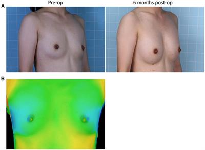 A Preliminary Exploratory Study of Autologous Fat Transplantation in Breast Augmentation With Different Fat Transplantation Planes